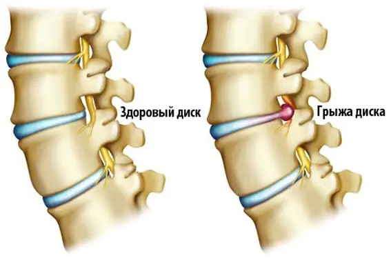 Spinal brok